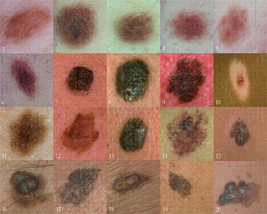 Tipos de cáncer de piel
