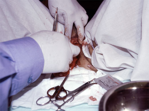 HIMENOPLASTIA
