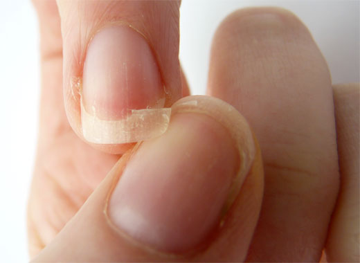 UÑAS QUEBRADIZAS