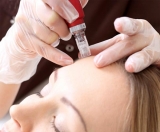 Aplicaciones y beneficios de la mesoterapia con peptonas
