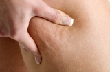 Celulitis: trastorno esttico y afeccin