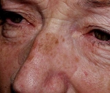 Melasma y lntigo, las manchas hiperpigmentadas ms habituales