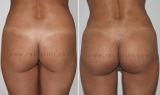 Inclusin gltea versus lipotransferencia