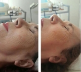 Fotoenvejecimiento: propuesta de tratamiento